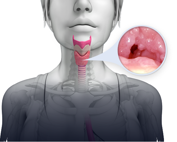 Throat showing recurrent
respiratory papillomatosis (RRP)
growths in the airway.