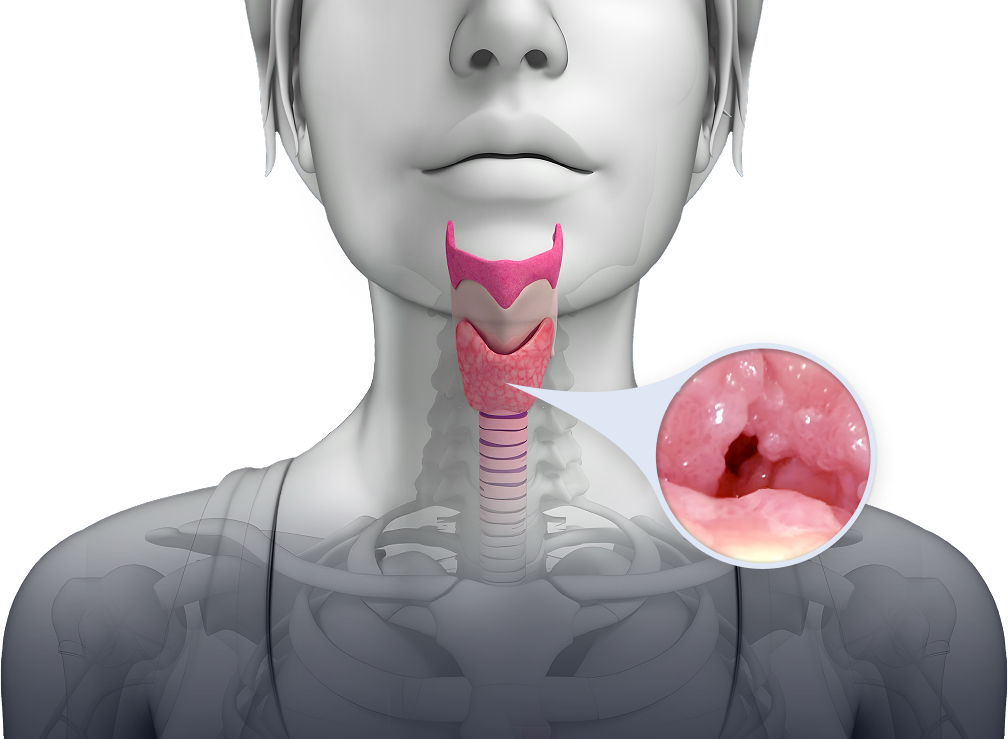 Throat showing recurrent
respiratory papillomatosis (RRP)
growths in the airway.